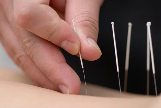 Метод сухой иглы Dry needling — предоплата